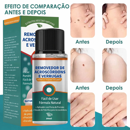 DermaClear – Removedor de Verrugas e Papilomas