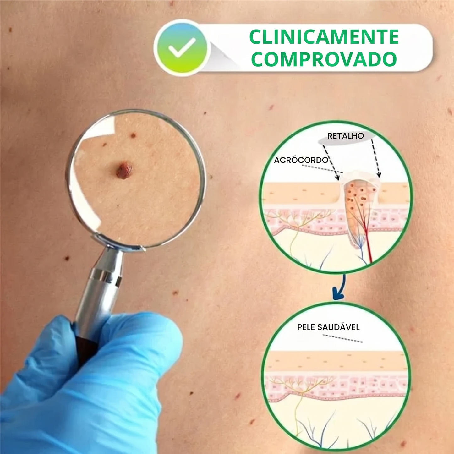 DermaClear – Removedor de Verrugas e Papilomas