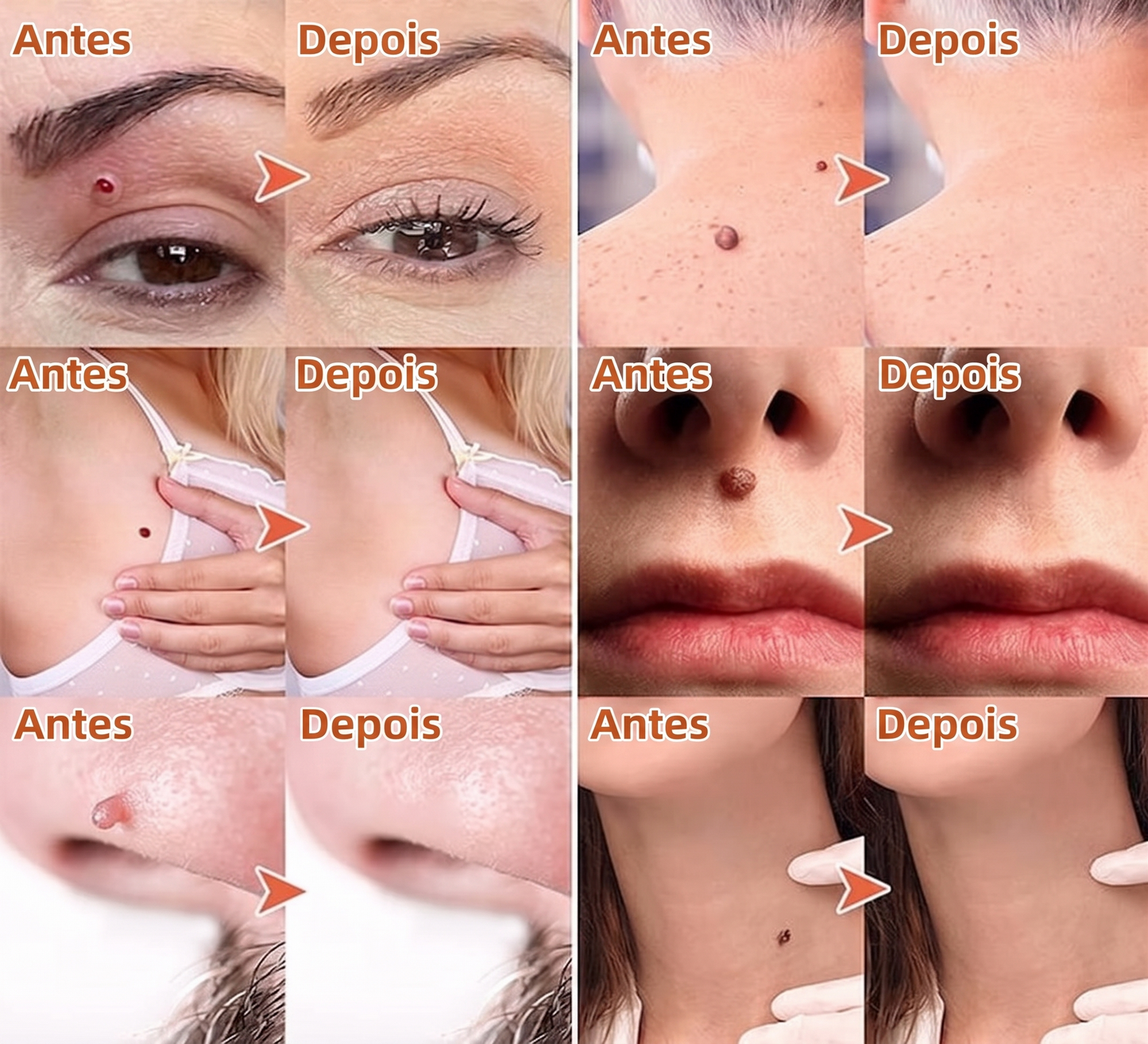 DermaClear – Removedor de Verrugas e Papilomas