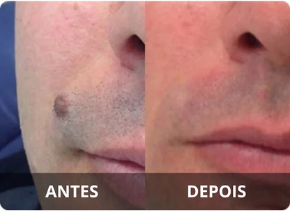 DermaClear – Removedor de Verrugas e Papilomas