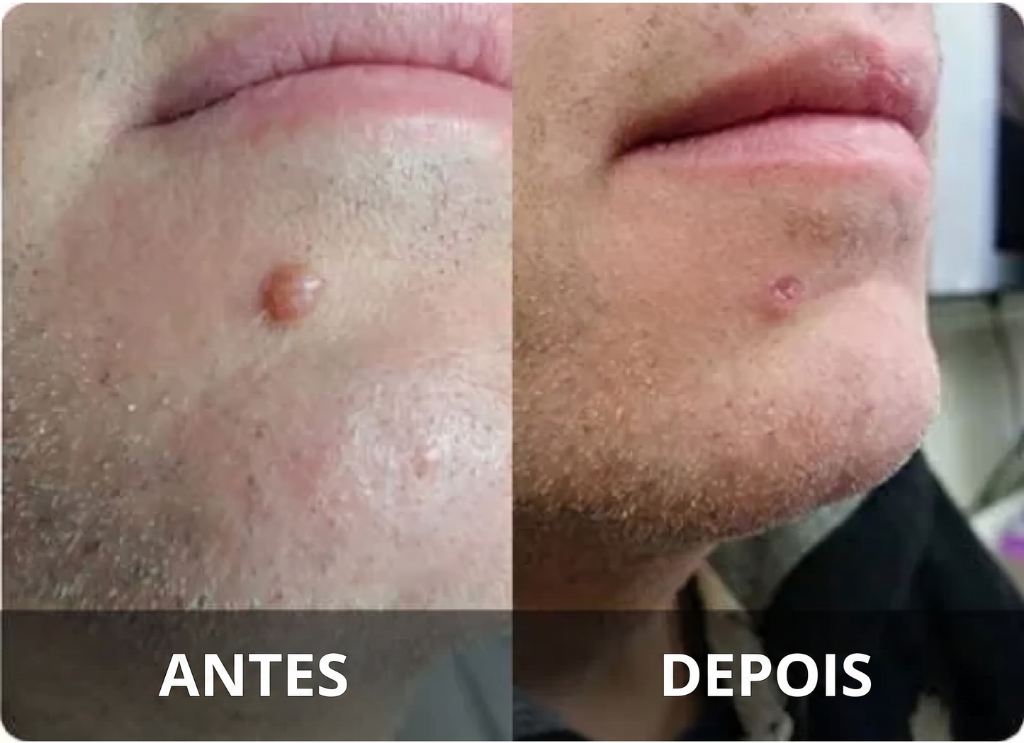 DermaClear – Removedor de Verrugas e Papilomas