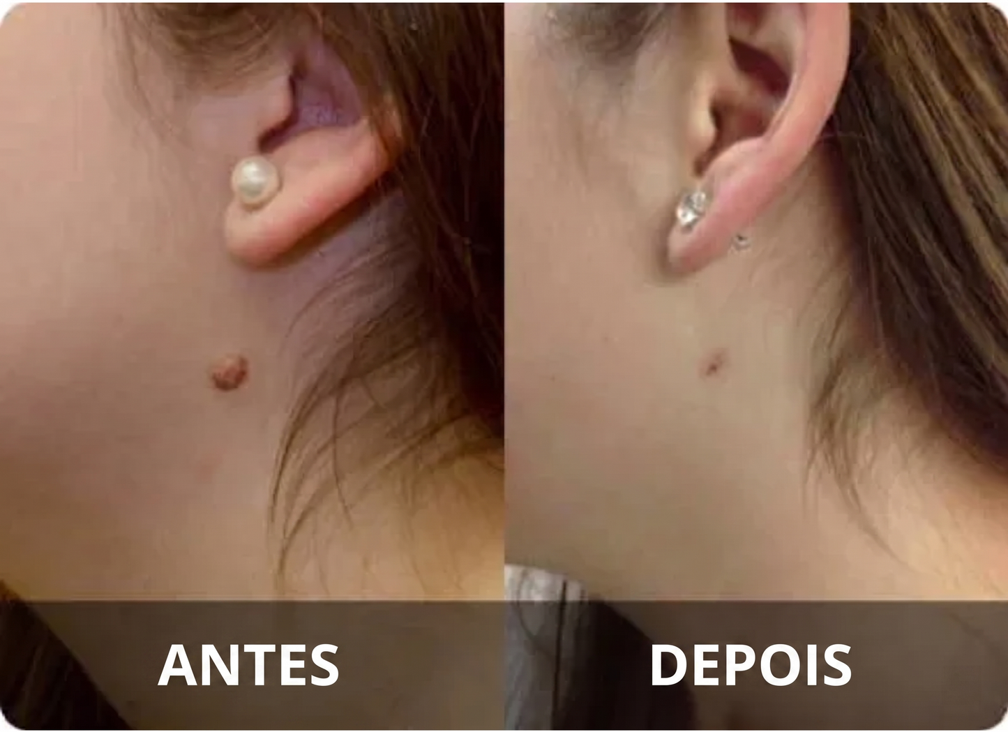 DermaClear – Removedor de Verrugas e Papilomas